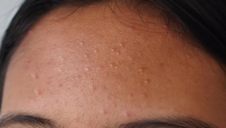Types of acne: From clogged pores to cysts 5 Usa People Types of acne: From clogged pores to cysts